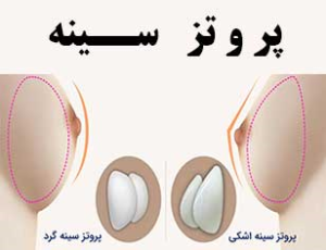 پروتز سینه المانی