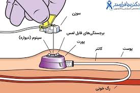 راهنمایی خرید  سوزن و دستگاه پورت