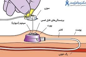 راهنمایی خرید  سوزن و دستگاه پورت